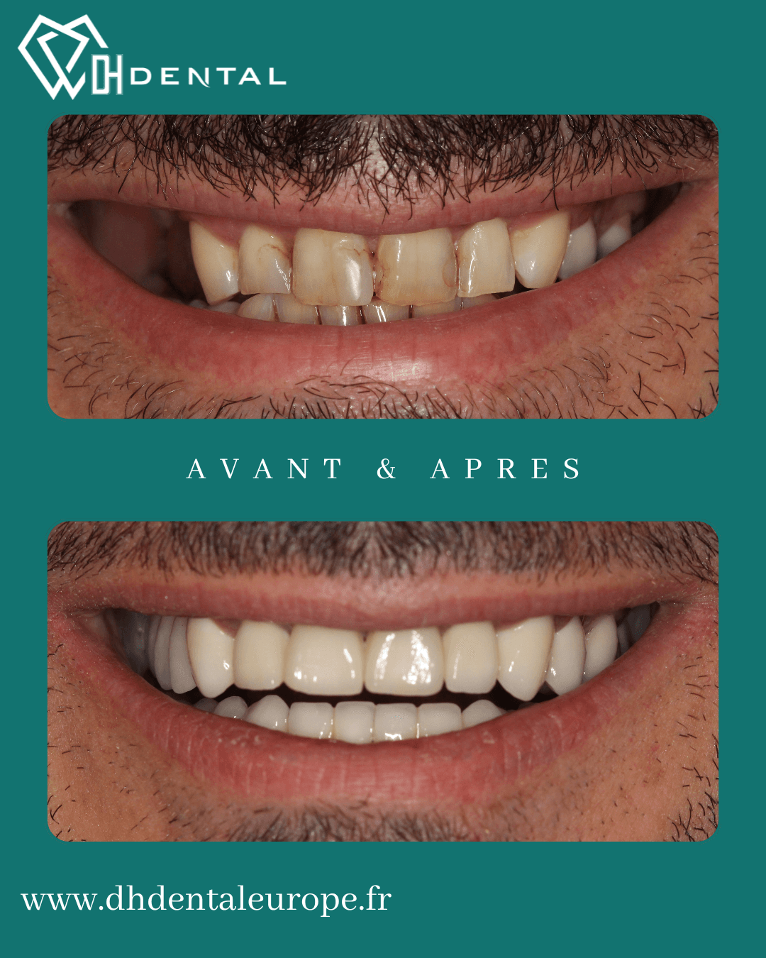 Couronnes zircones_DHDental (2)