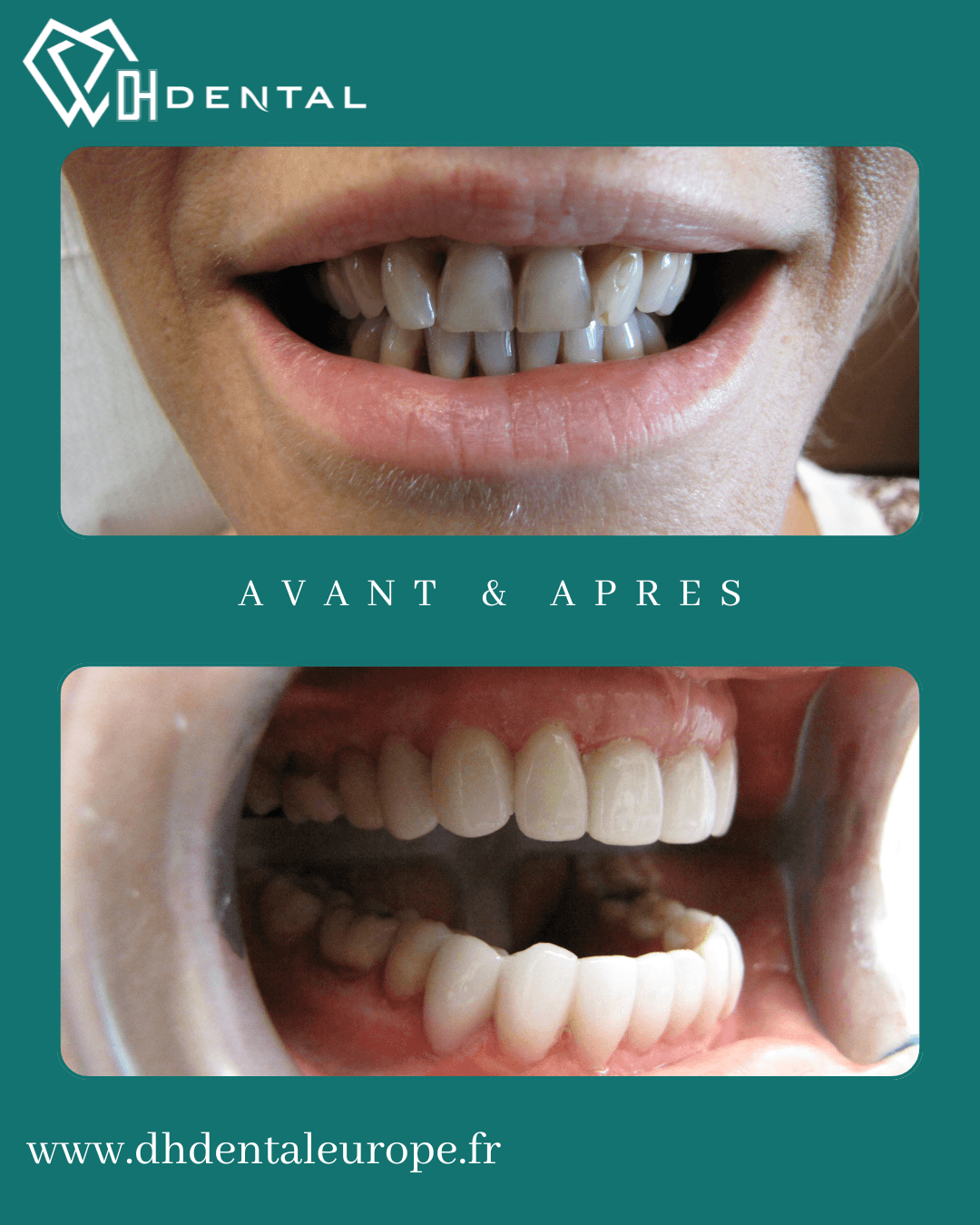 Facettes céramiques (2)