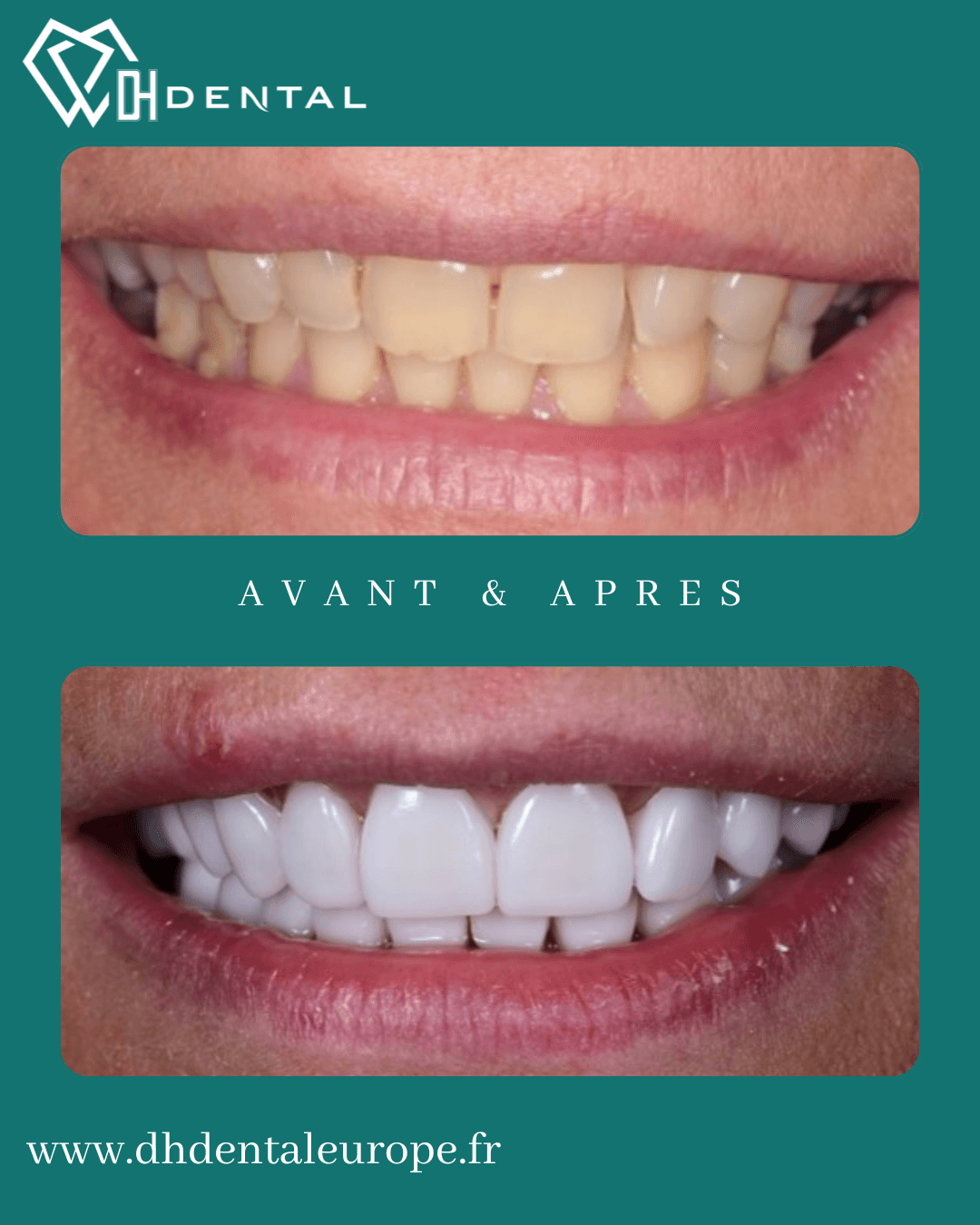 Facettes céramiques