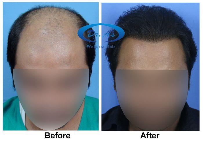 7196 grafts . 54 months update- Dr. A’s Clinic (3964 FUSE/fue grafts + 2893 beard grafts + 339 FUSE/fue grafts)