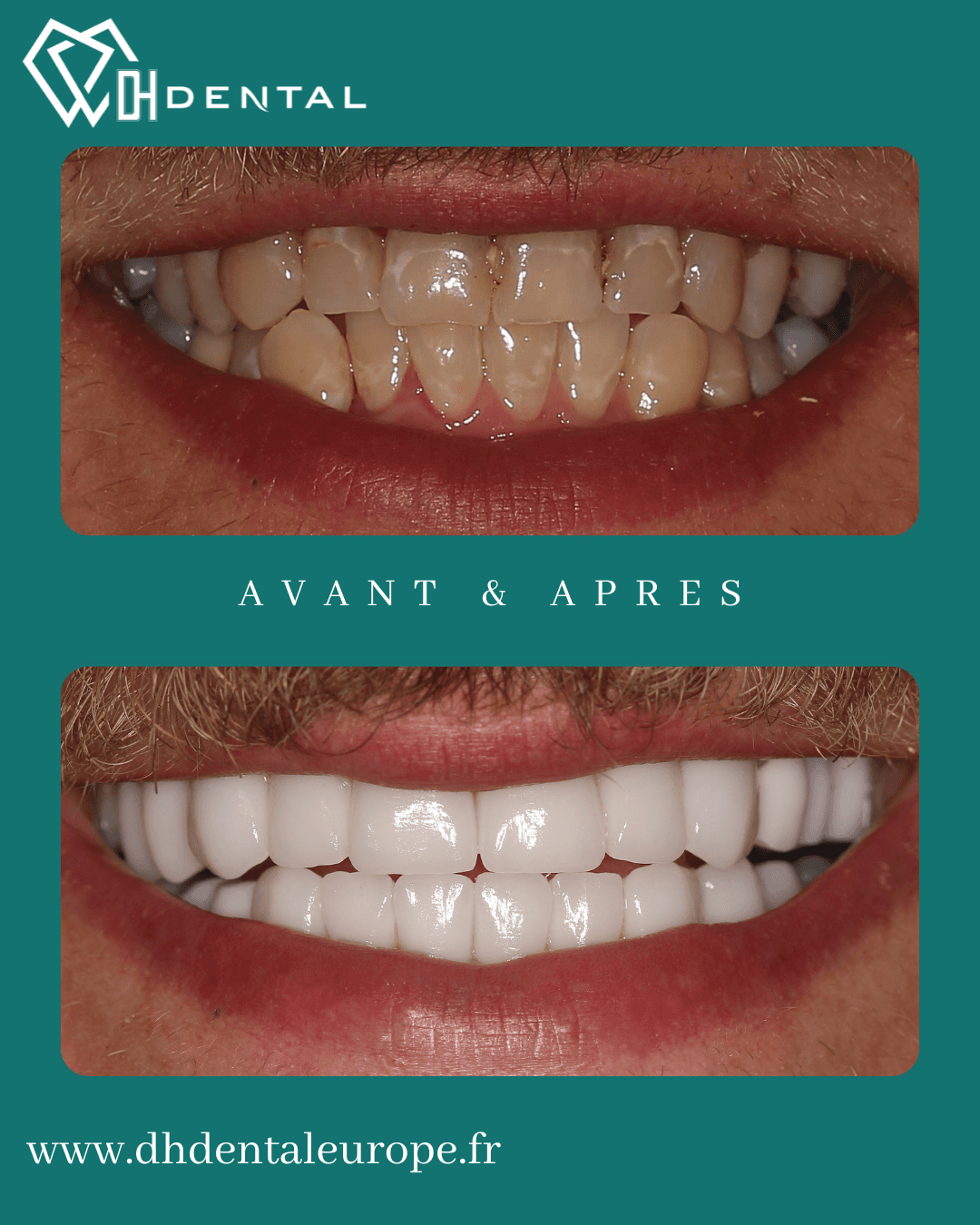 Couronnes zircones (1)