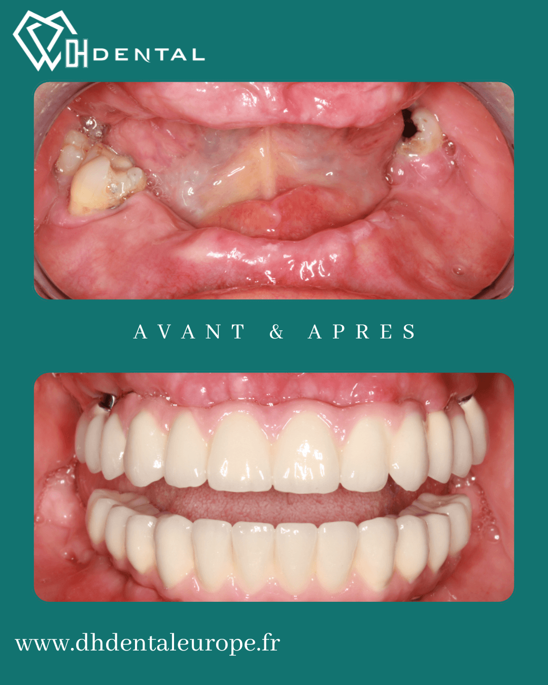 Réhabilitation totale