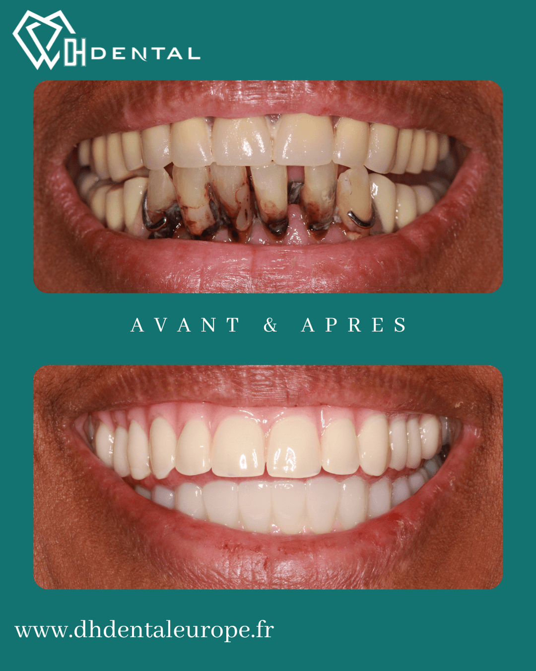 All-on-4 chez DH Dental