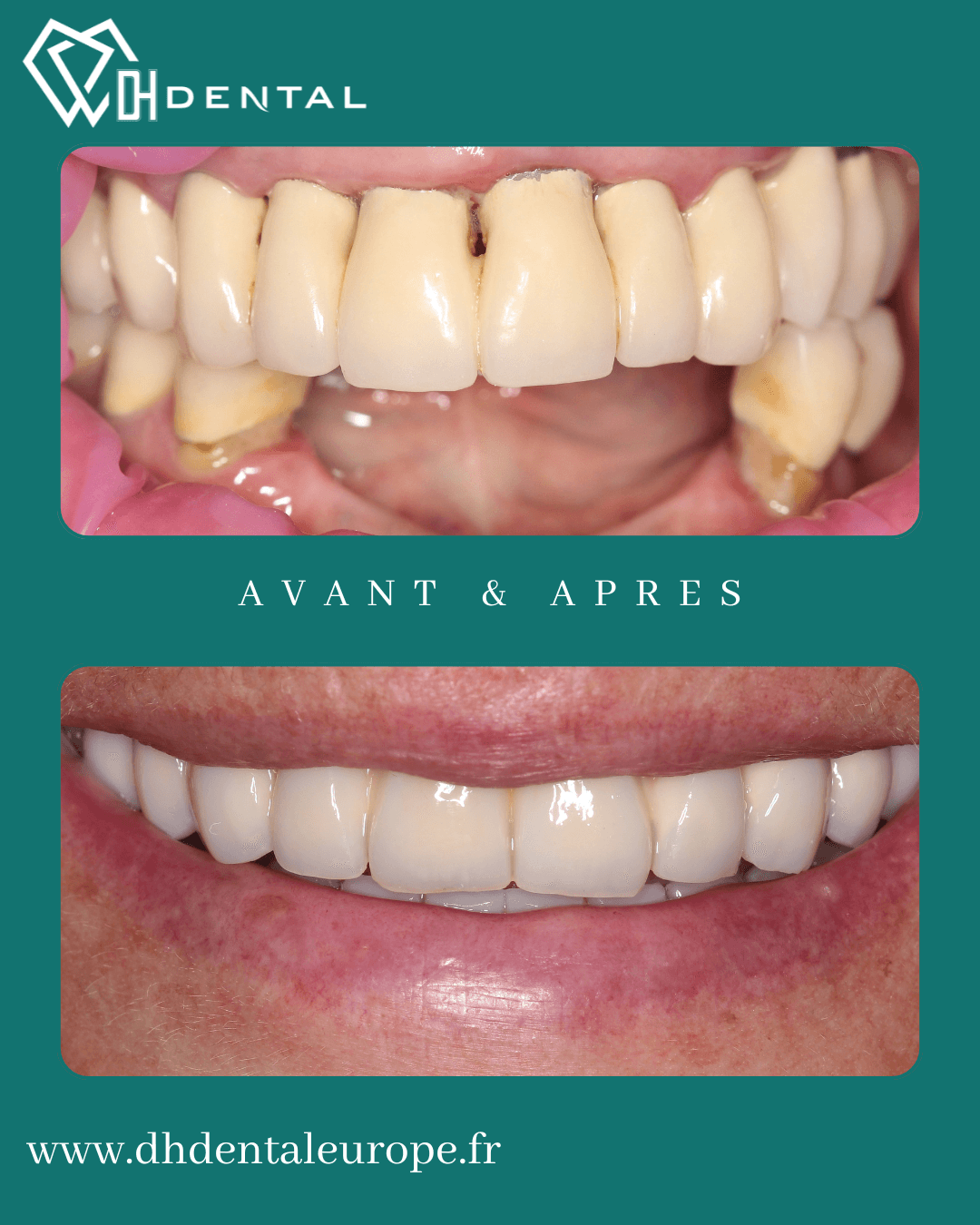 All-on-4 en haut et en bas