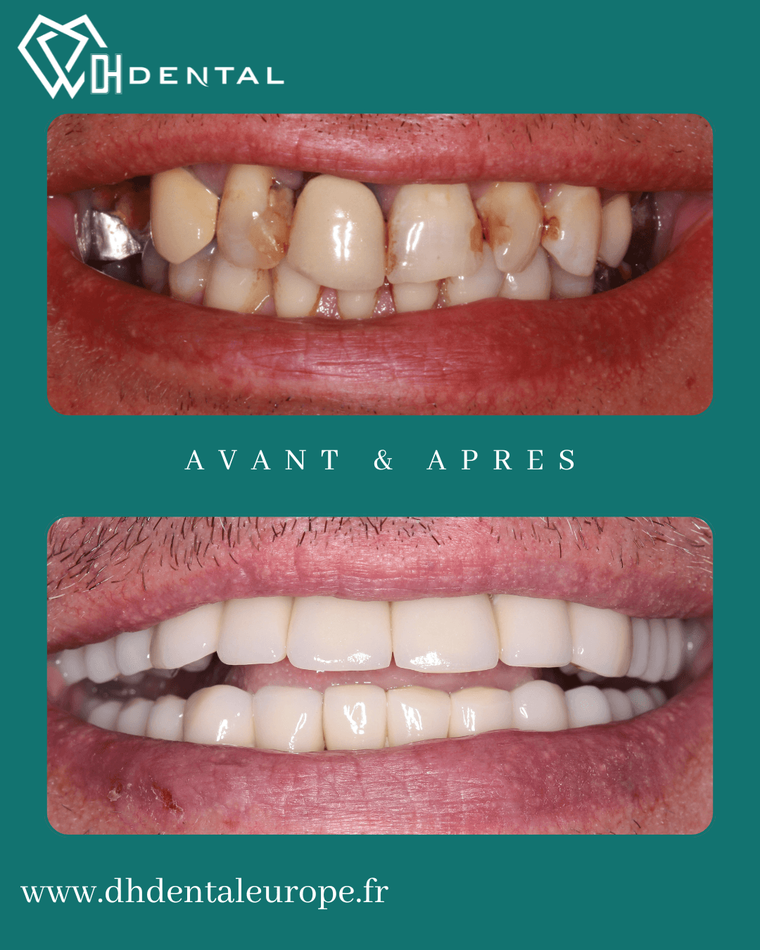 Couronnes dentaires chez DH Dental