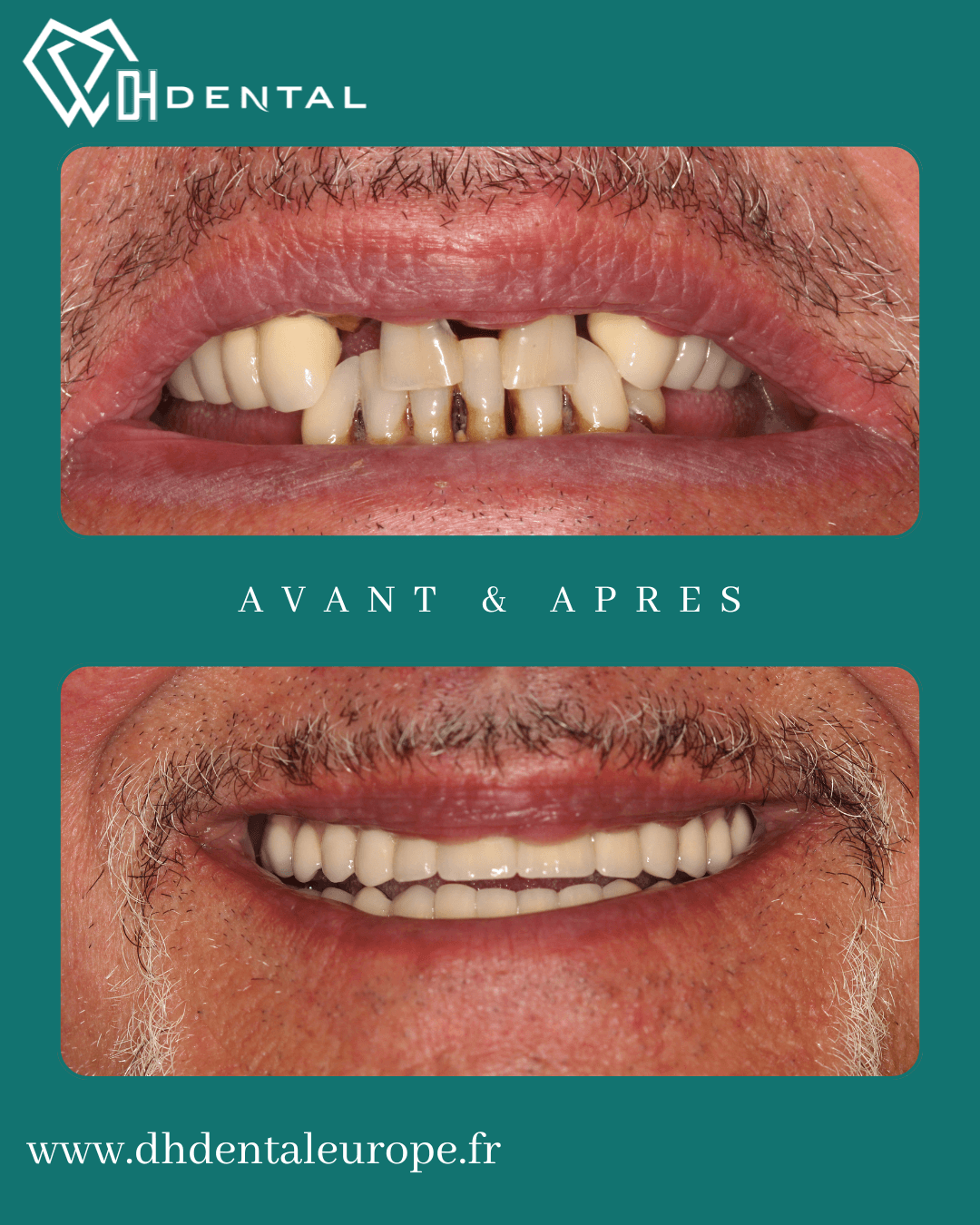 All-on-6 chez DH Dental