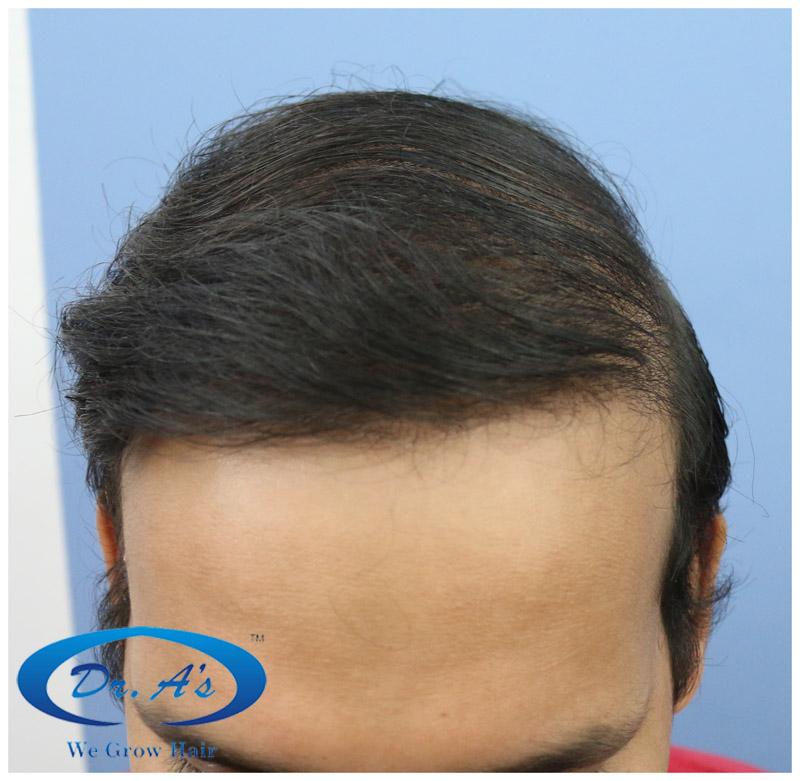 After picture 512_02