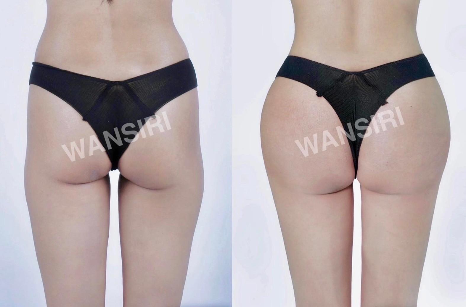 LINE_ALBUM_เคสเสริมก้น_250515_2