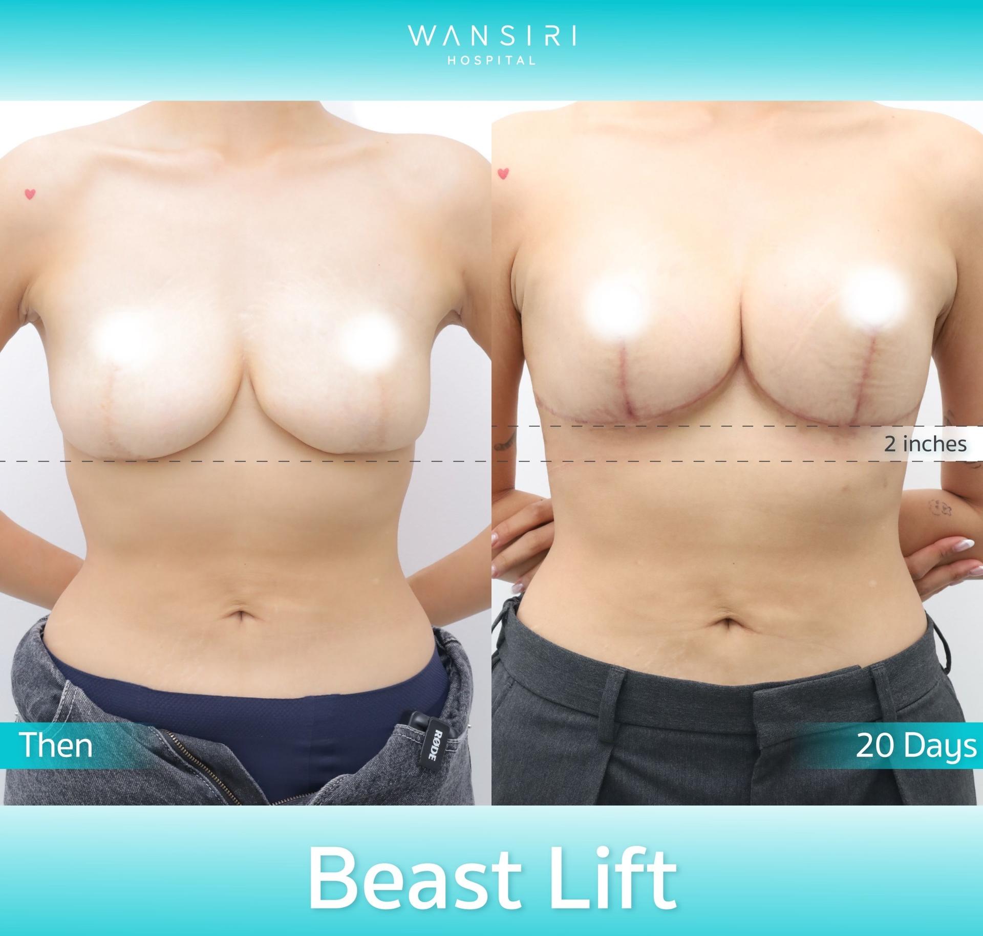Wansiri Hospital Bangkok Breast Lift