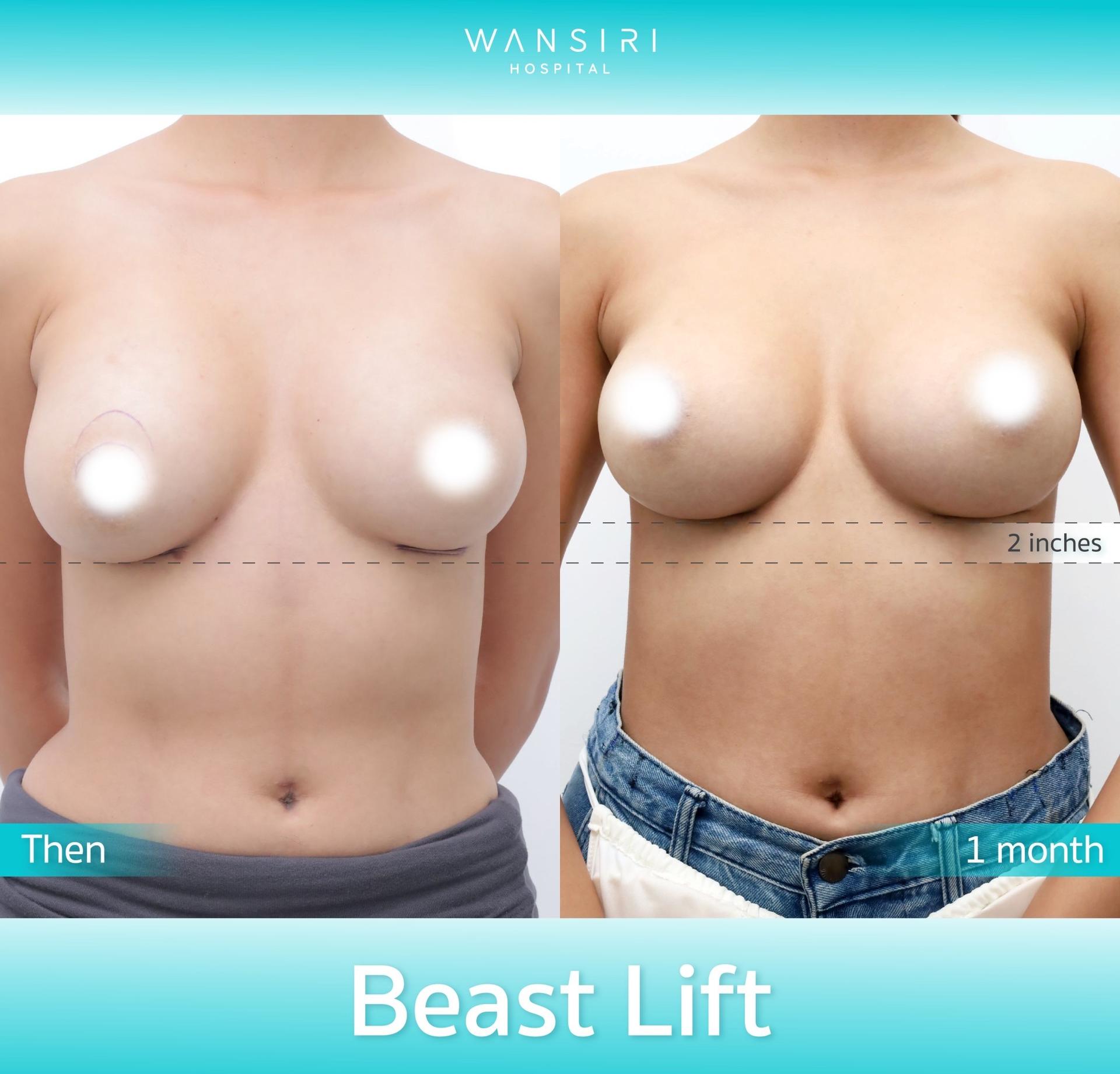 Wansiri Hospital Bangkok Breast Lift