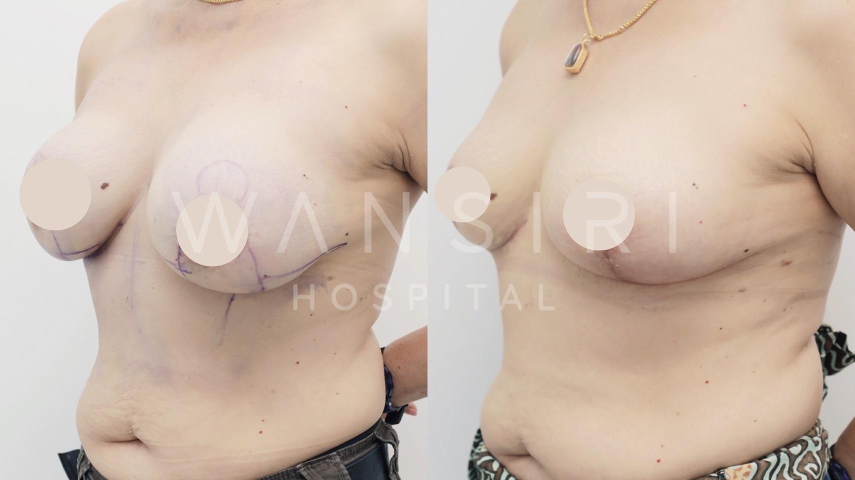 Wansiri Hospital Bangkok Breast Lift