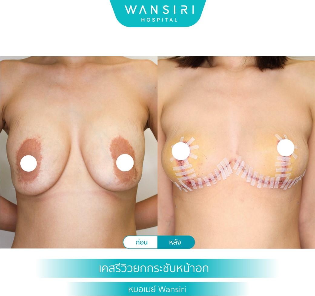 Wansiri Hospital Bangkok Breast Lift