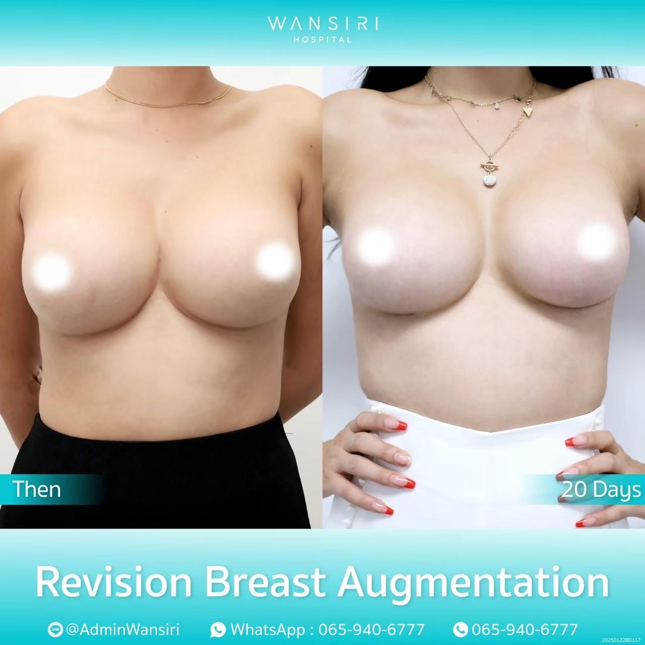Wansiri breast augmentation