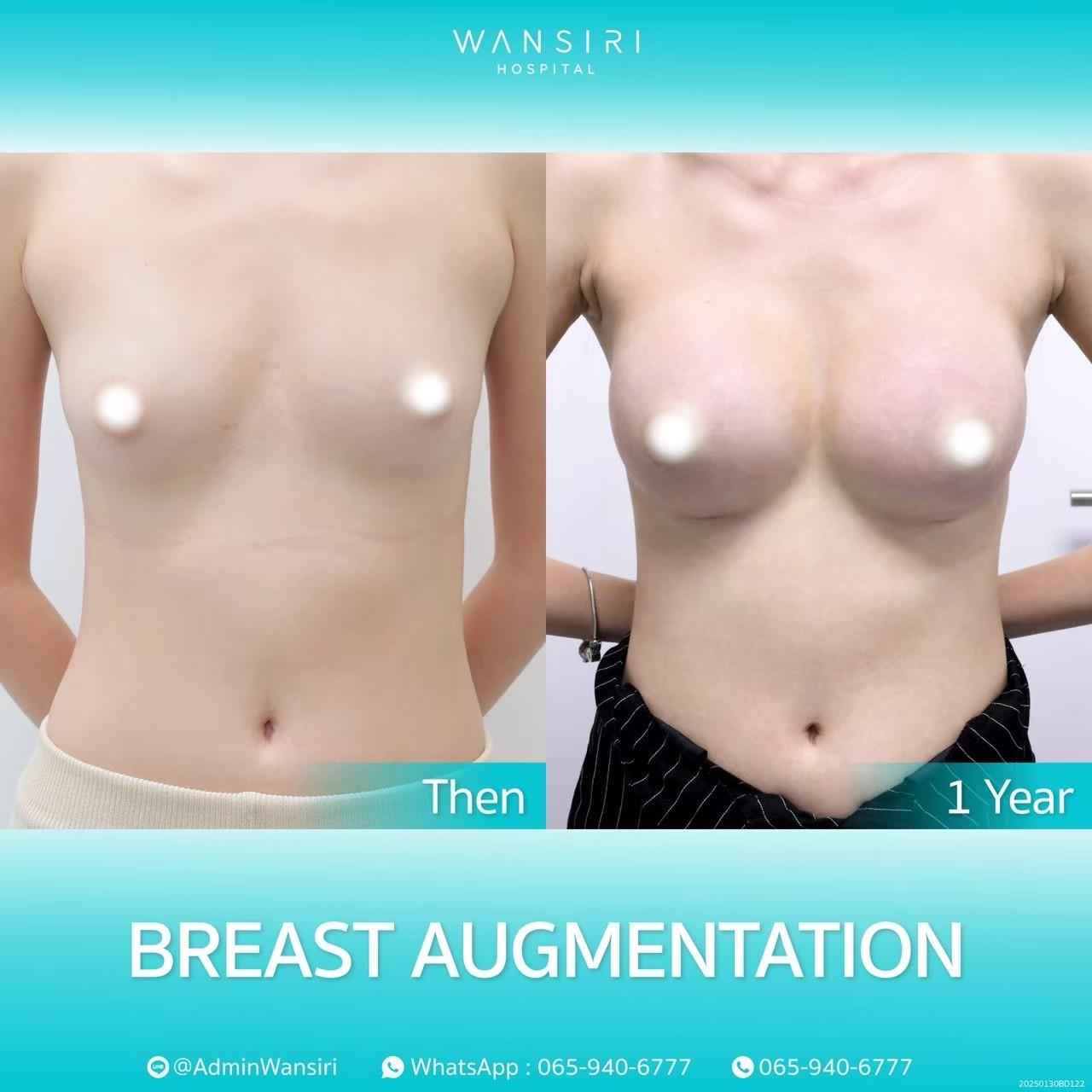 LINE_ALBUM_เสริมหน้าอก_250430_104