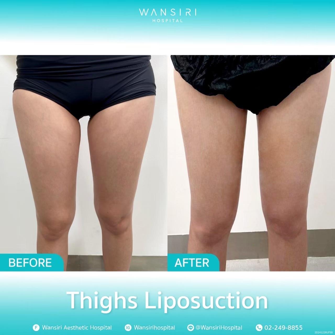 Wansiri Hospital Bangkok Liposuccion