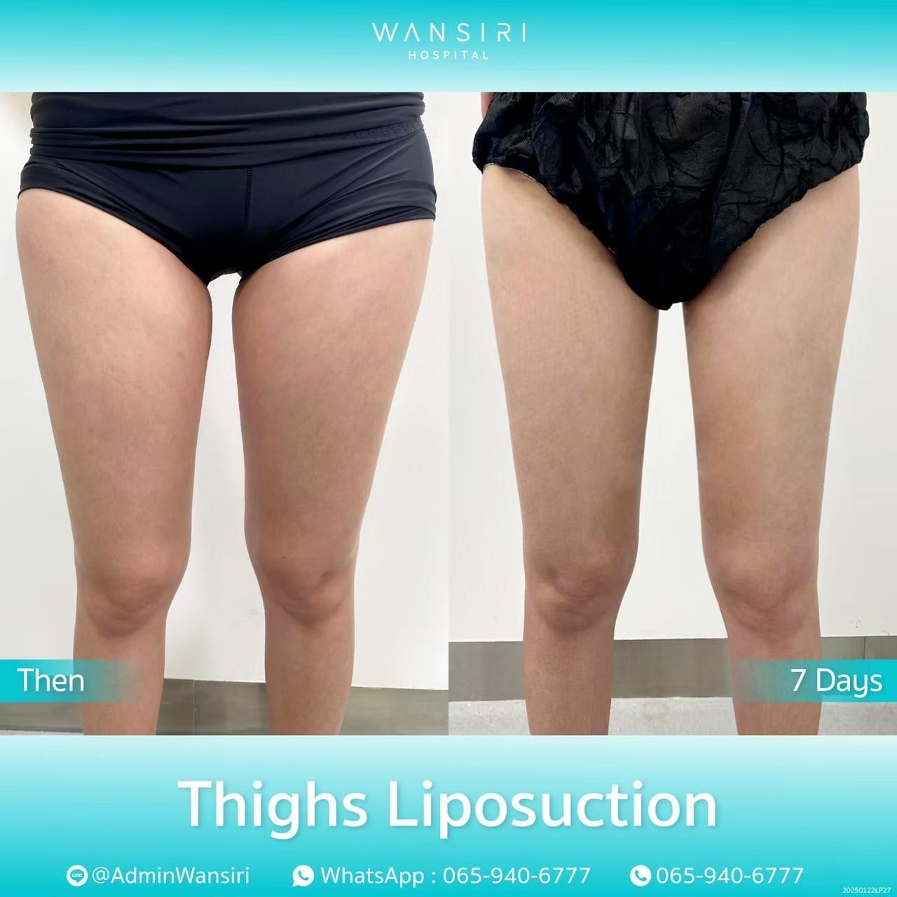 LINE_ALBUM_Thighs Liposuction_250515_2