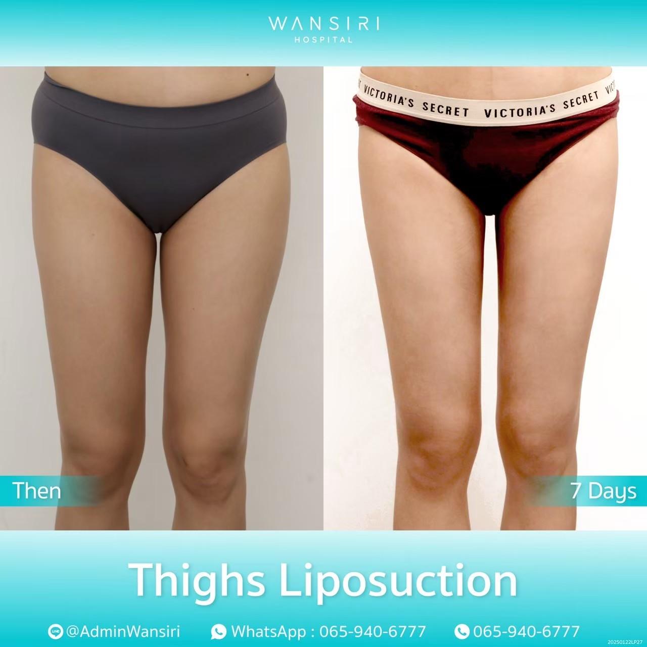 LINE_ALBUM_Thighs Liposuction_250515_3