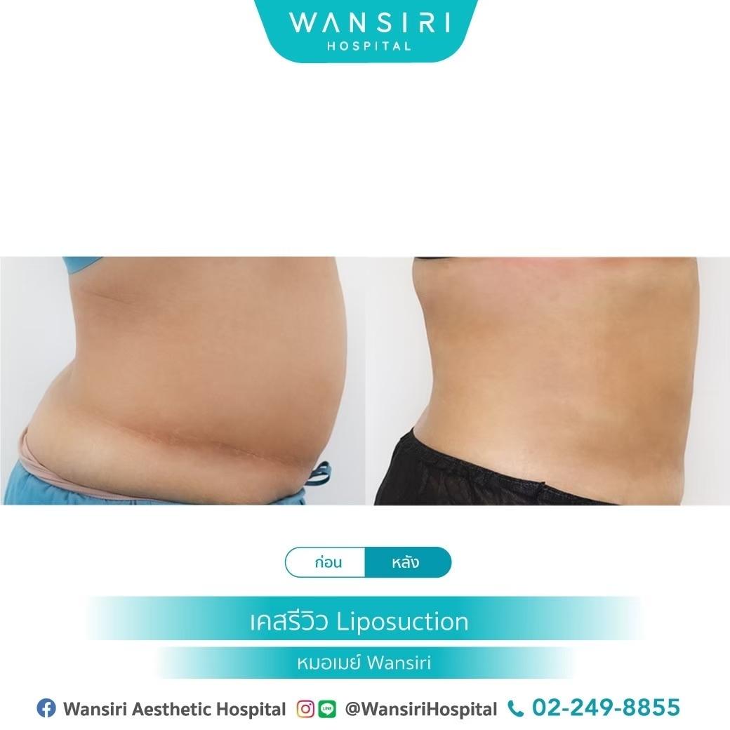 LINE_ALBUM_ดูดไขมันหน้าท้อง_250430_1