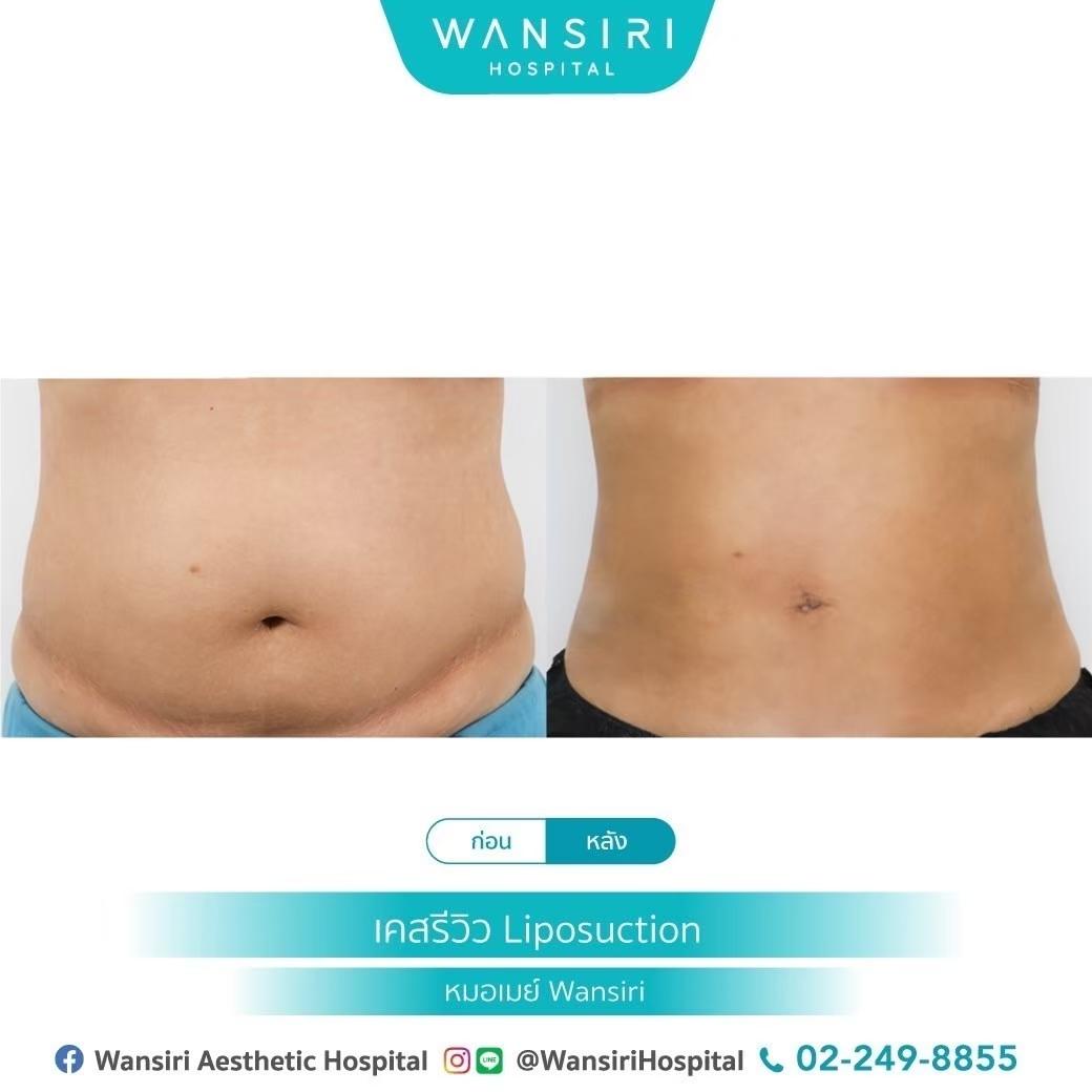 LINE_ALBUM_ดูดไขมันหน้าท้อง_250430_2