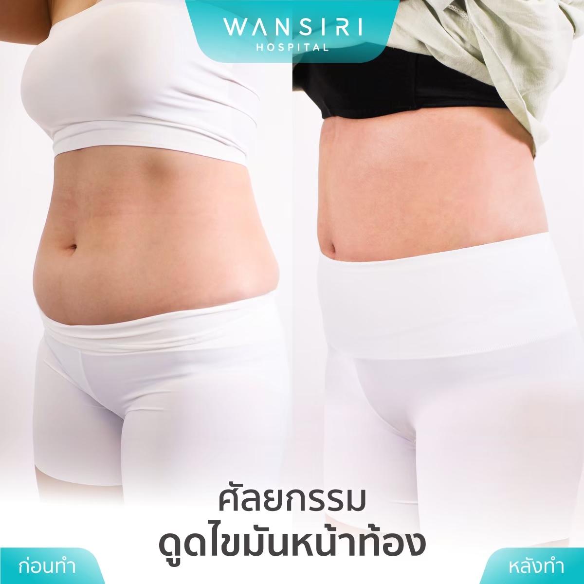 Wansiri Hospital Bangkok Liposuccion