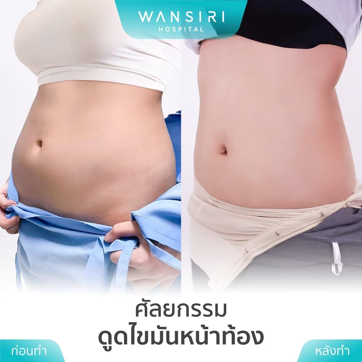 Wansiri Hospital Bangkok Liposuccion