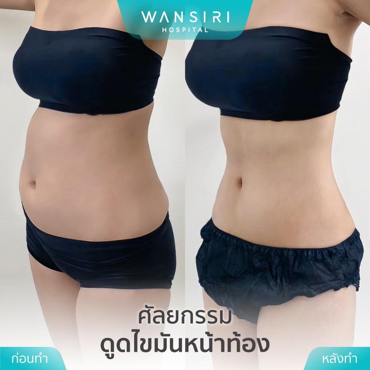 Wansiri Hospital Bangkok Liposuccion