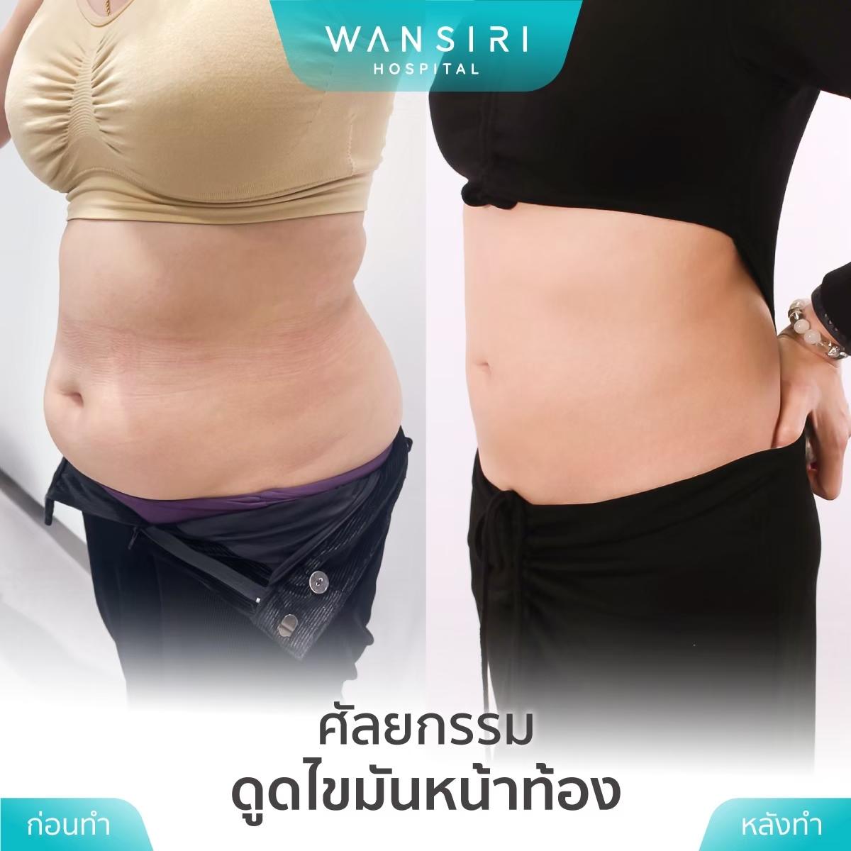 Wansiri Hospital Bangkok Liposuccion