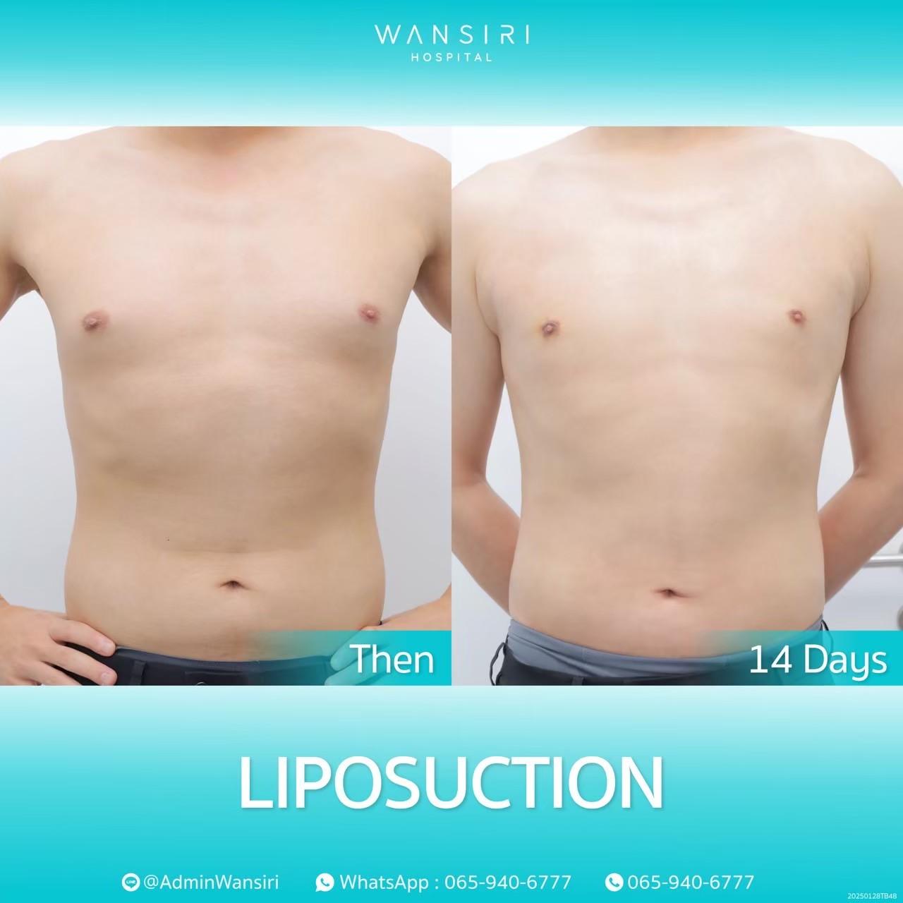 Wansiri Hospital Bangkok Liposuccion