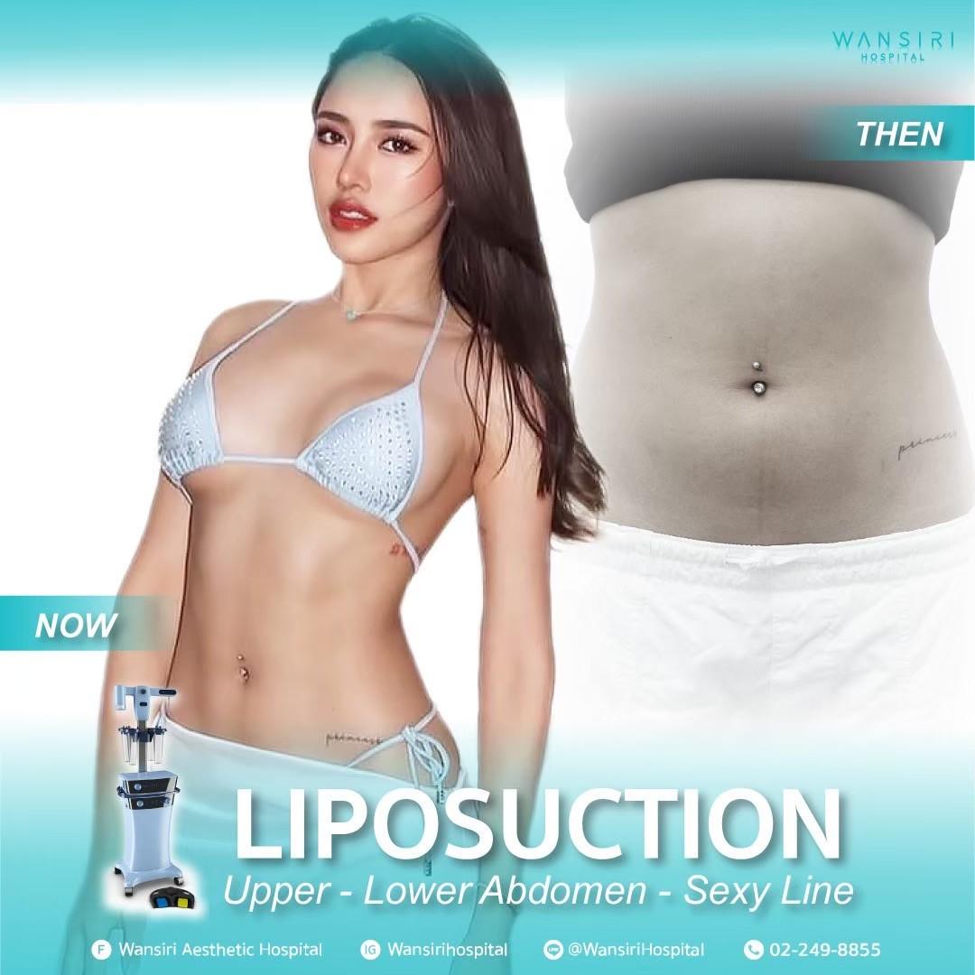 Wansiri Hospital Bangkok Liposuccion