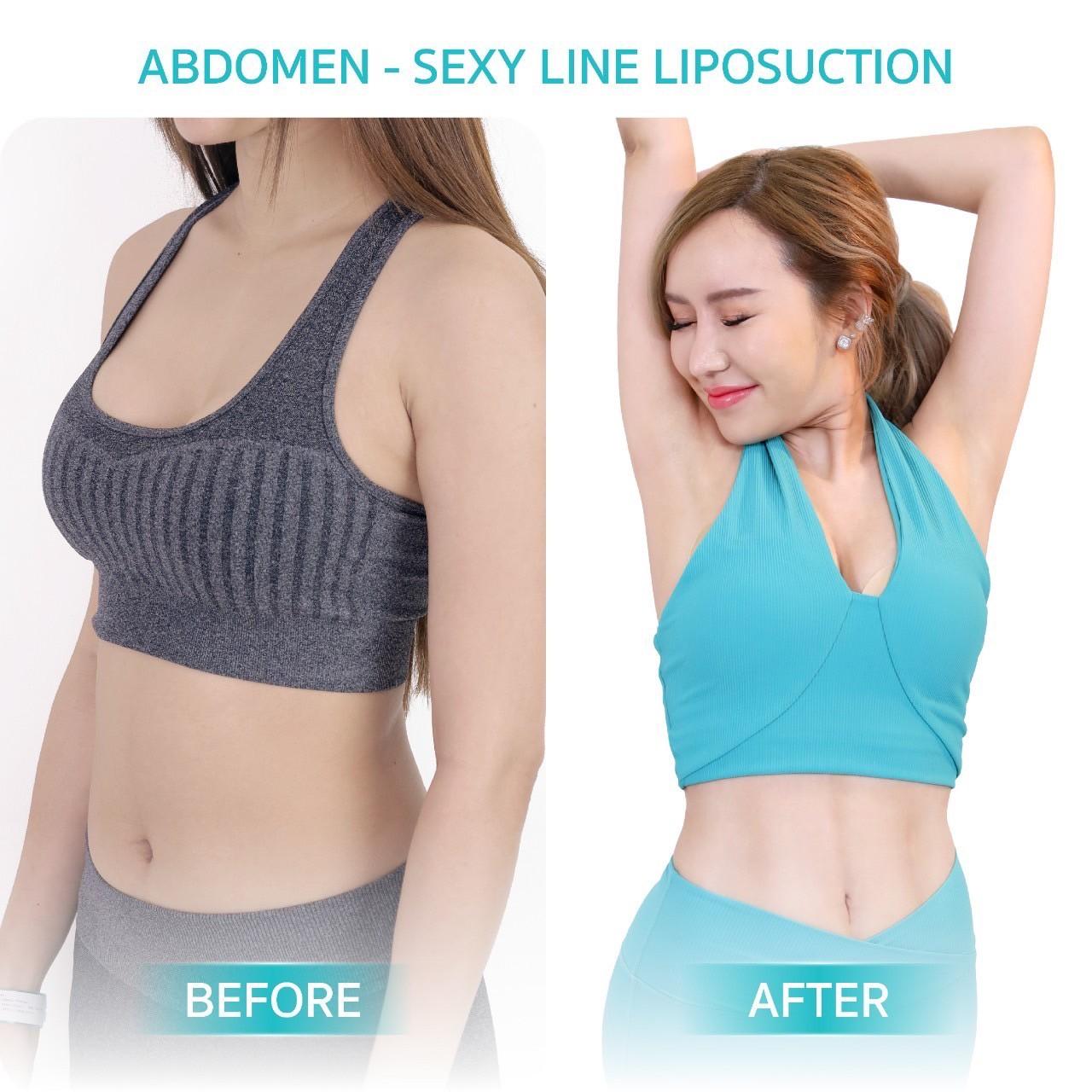 Wansiri Hospital Bangkok Liposuccion