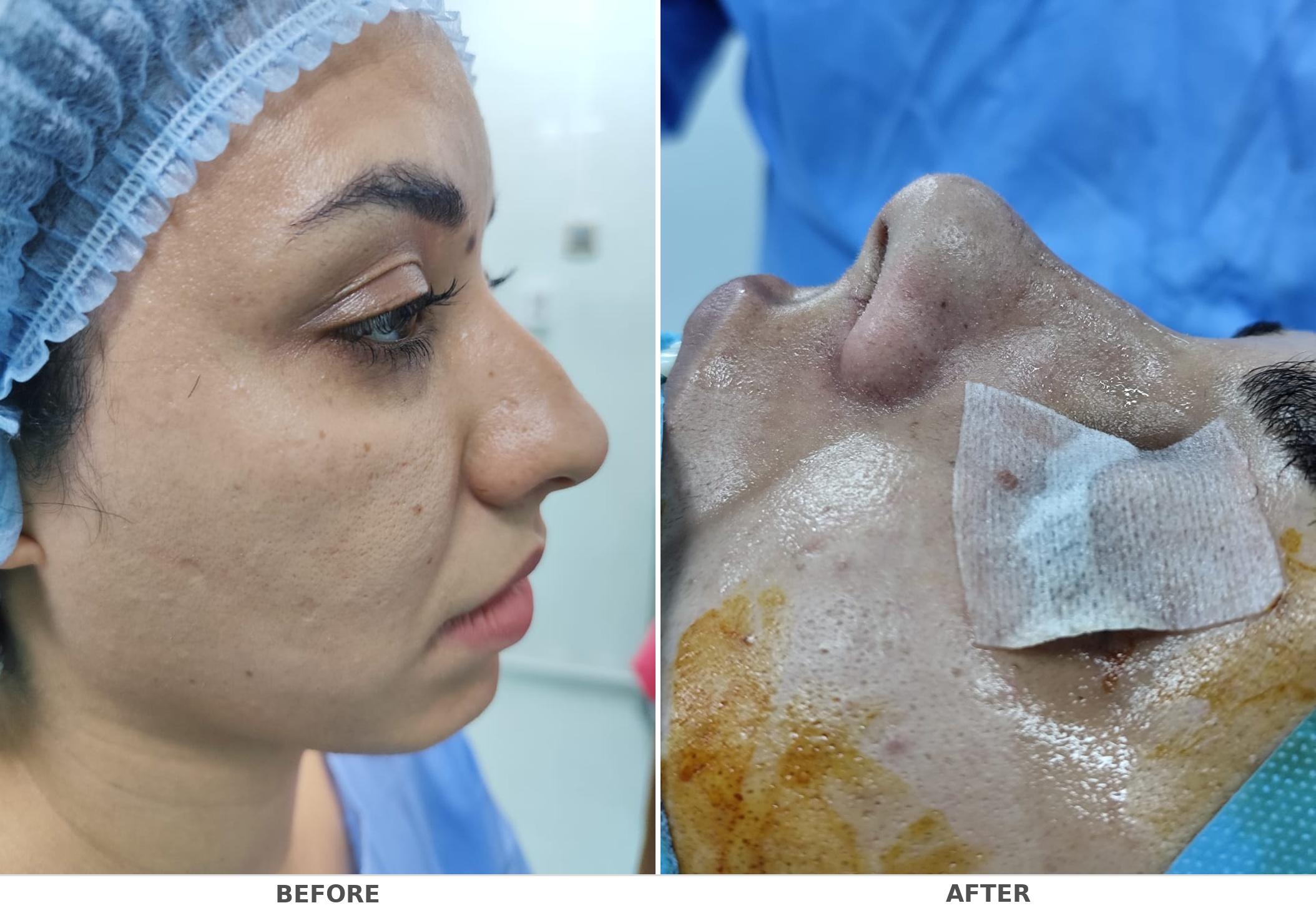 rhinoplasty_before_after