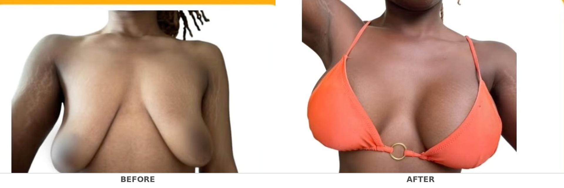 breast_before_after