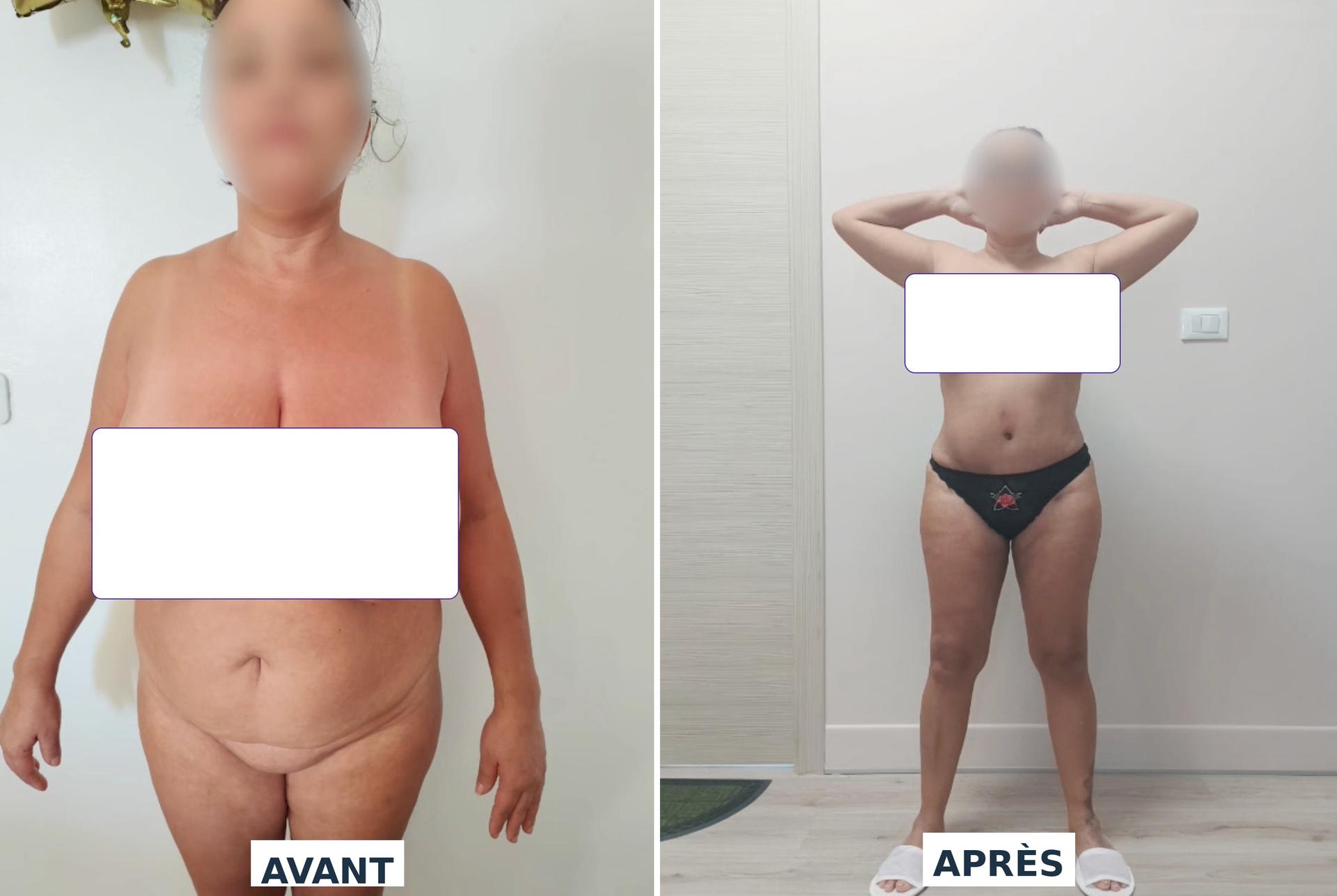 Abdominoplastie Dr Maalej