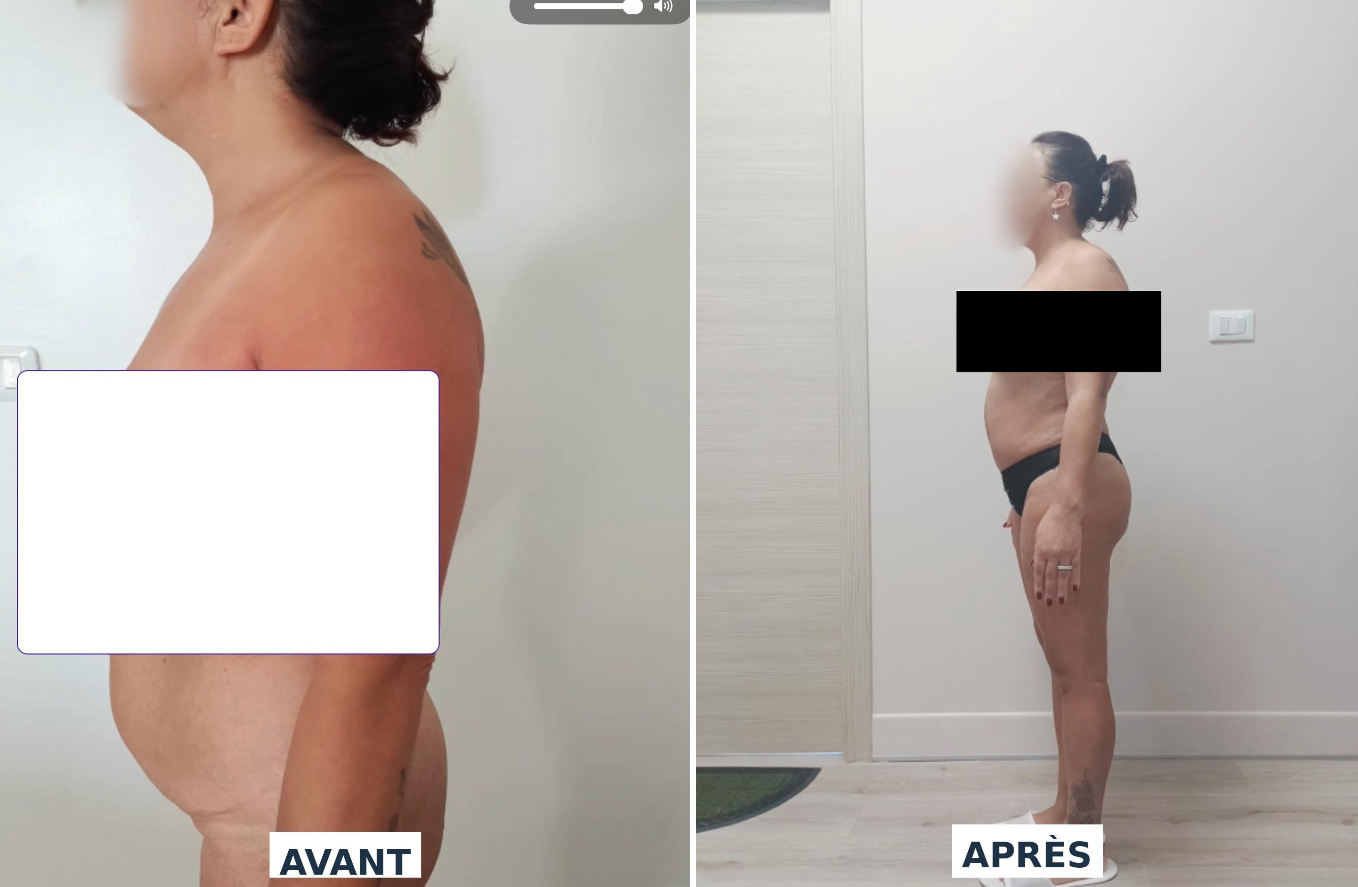 Abdominoplastie Dr Maalej