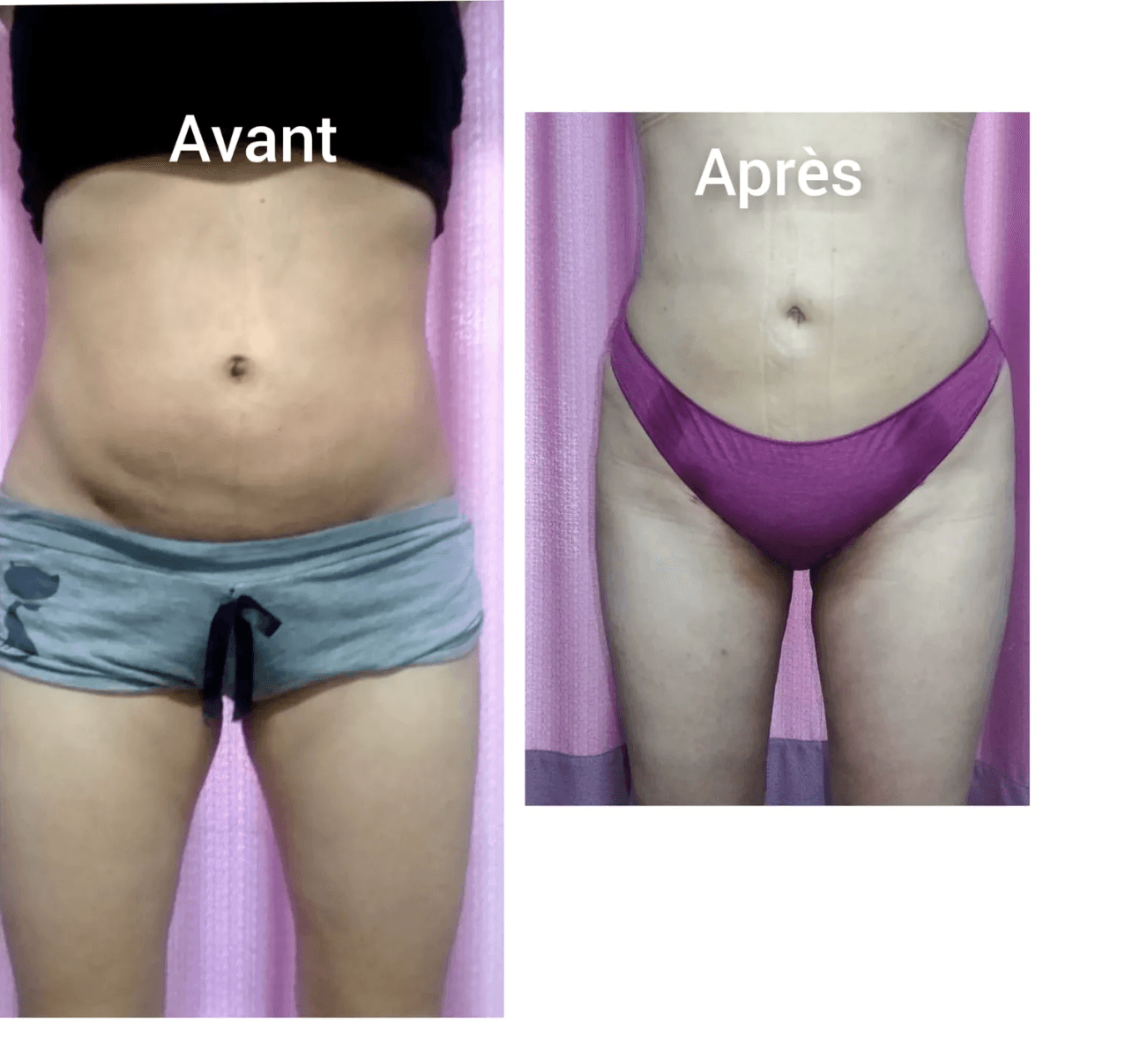 Abdominoplastie Dr Maalej