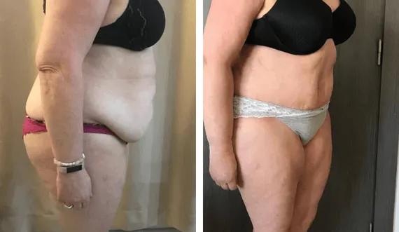 Abdominoplasty-tummy tuck (1)
