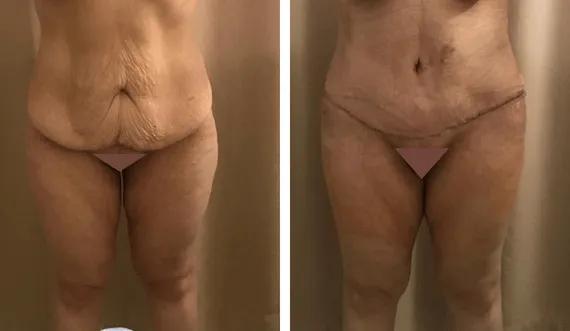 Abdominoplasty-tummy tuck (2)
