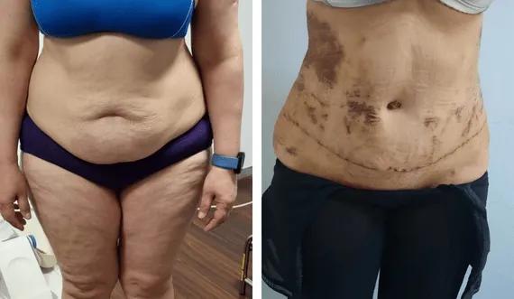 Abdominoplasty-tummy tuck (3)