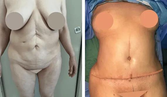 Abdominoplasty-tummy tuck (4)