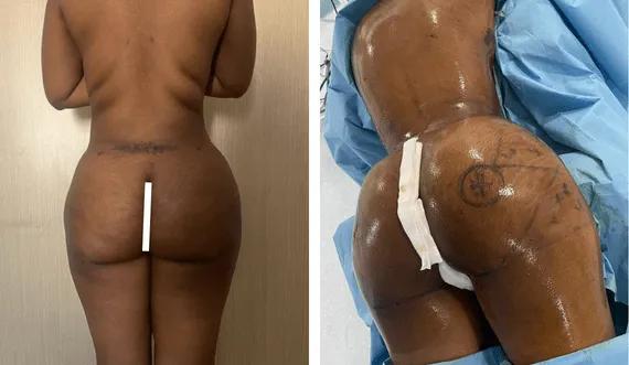 Buttock Lipofilling-BBL (1)