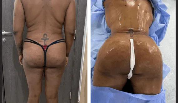 Buttock Lipofilling-BBL (2)