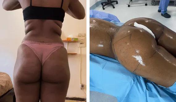 Buttock Lipofilling-BBL (3)