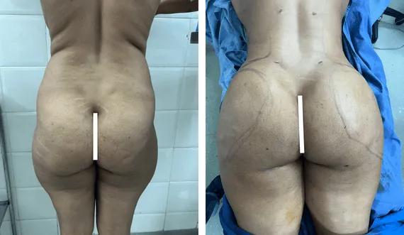 Buttock Lipofilling-BBL (4)