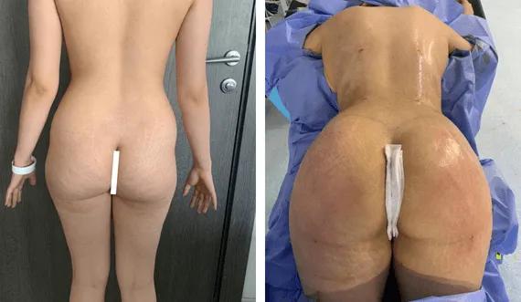 Buttock Lipofilling-BBL (5)