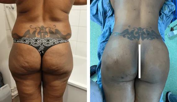 Buttock Lipofilling-BBL (7)