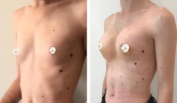 Breast Augmentation (1)