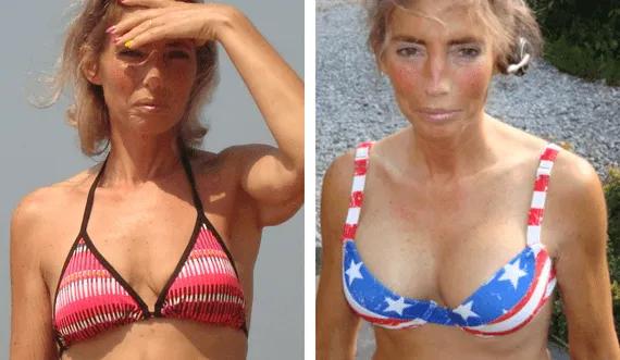 Breast Augmentation (2)