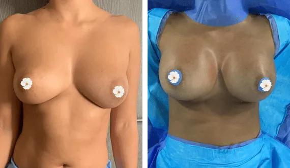 Breast Augmentation (3)