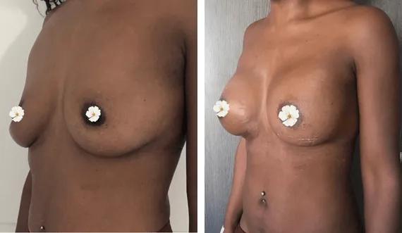 Breast Augmentation (4)
