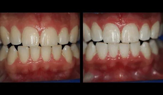 Teeth whitening (1)